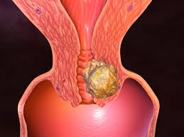 uterus cancer