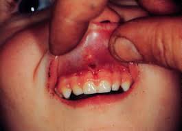 Torn frenulum.