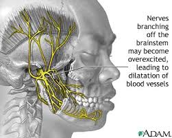 migraine symptoms