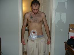colonoscopy bag