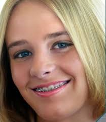 braces pictures