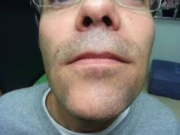 beard alopecia