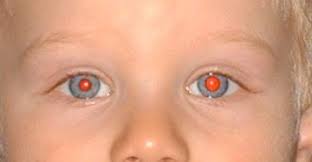 physiologic anisocoria