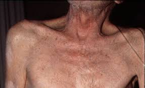 severe copd