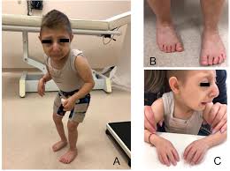 Image result for Nanismo Primordial