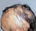 Alopecia Nervosa