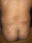 Hypopigmented <b>mycosis fungoides</b> in a 10-year-old boy