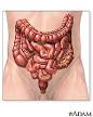 Diverticulosis and DIVERTICULITIS: MedlinePlus