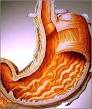 gastritis.jpg