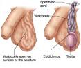 <b>Varicocele</b>