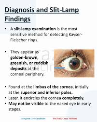 Kuvahaun tulos haulle Kayser-Fleischer