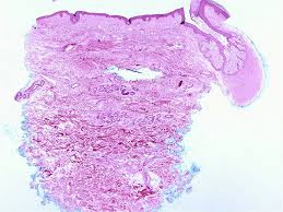 Attēlu rezultāti vaicājumam “Diderma chondrioderma sessile”