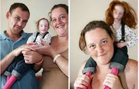 Image result for Nanismo Primordial