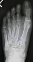 Lisfranc fracture - Wikipedia, the free encyclopedia