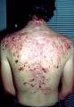 Severe acne vulgaris