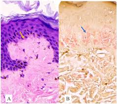 Attēlu rezultāti vaicājumam “Diderma umbilicatum young”