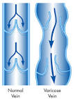 Varicose <b>Veins</b>