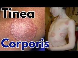 Image result for tinea corporis