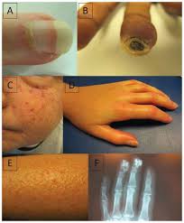 Attēlu rezultāti vaicājumam “Scleroderma”