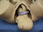 <b>Nuchal Cord</b>