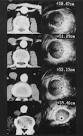 Accurate assessment of abdominal aortic aneurysm with