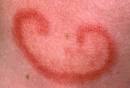 Pictures of Lupus: Rash , Symptoms, Joint Pain, Tests, and Treatments