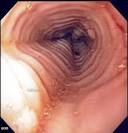 File:Eosinophilic esophagitis endo.jpg - Wikipedia, the free ...