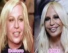 Fresh Pics  16 Worst Celebrity Plastic Surgery Disasters