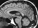 <b>Dandy Walker Syndrome</b>