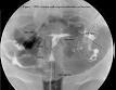 Asherman's syndrome - Wikipedia, the free encyclopedia