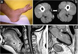 Attēlu rezultāti vaicājumam “Tetanops myopina”
