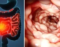 Image result for boala crohn si schizofrenie paranoida