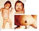 <b>congenital hypothyroidism</b>.
