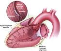 Hypertrophic Cardiomyopathy