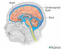 <b>Cerebrospinal fluid</b> leak: