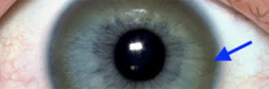 Kuvahaun tulos haulle Kayser-Fleischer