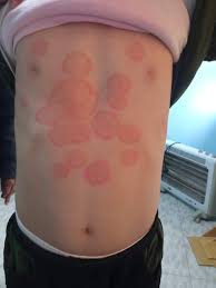 Image result for tinea corporis