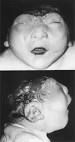 ANENCEPHALY