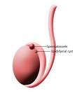 <b>Spermatocele</b> Recovery Time