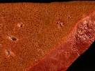 Case 21 --Transplant Pathology Case