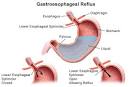 Gastroesophageal Reflux Disease (GERD) / Heartburn | CHOP | The ...
