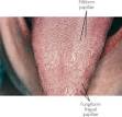 papilla - definition of papilla in the Medical dictionary - by the ...