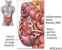 Inflammatory bowel disease -