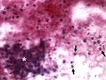 <b>Churg</b>-<b>Strauss syndrome</b> in a