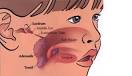 Teeth grinding in children | Dr. Tracey Hughes' Blog