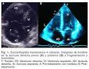Archivos de cardiología de México - Tromboembolia pulmonar masiva