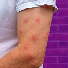 Image result for bed bug bites