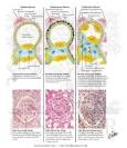 Pathology of the <b>Nephrotic Syndrome</b> - Netter Medical Artwork