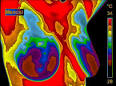 http://4.bp.blogspot.com/_gP6t_r-nMJY/TMbY3KbKqbI/AAAAAAAAAwE/FEWqZz8VHSo/s1600/Breast%252BThermogray%252BImage.gif