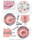 Cervical Intraepithelial Neoplasia - Netter Medical Images